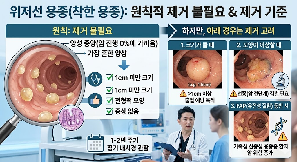 위저선 용종 제거 필요 여부