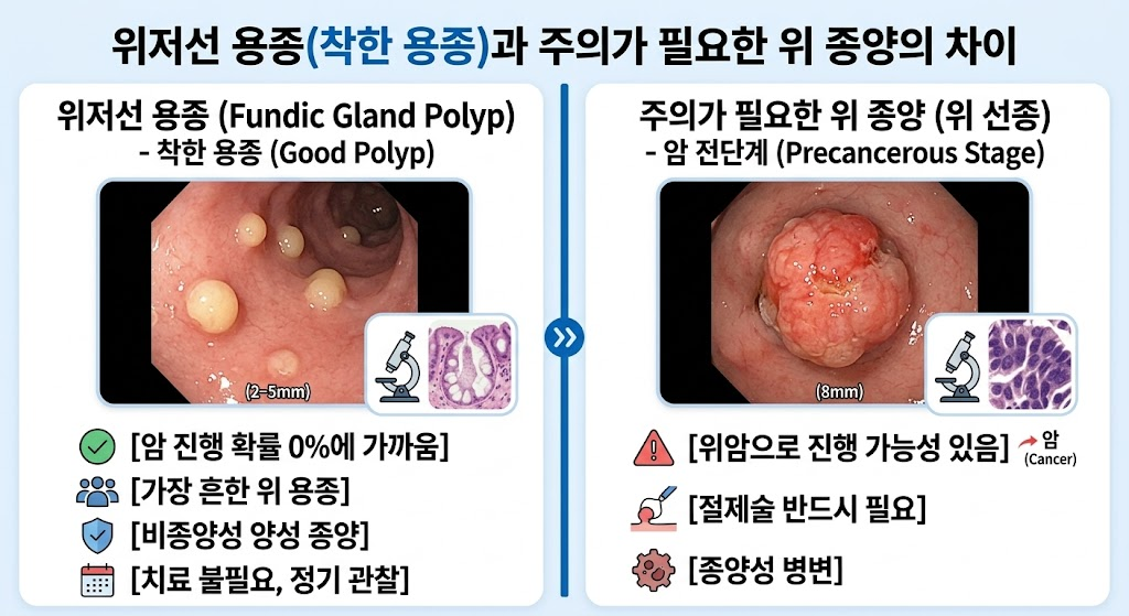 위저선 용종과 위험한 위 종양의 차이 설명